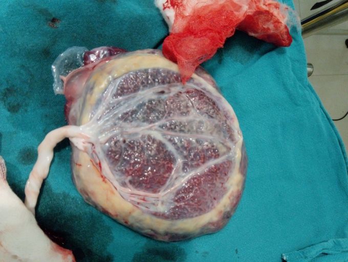 Battledore placenta