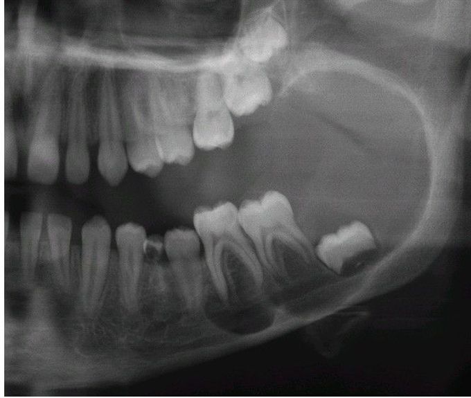 Unicystic Ameloblastoma.