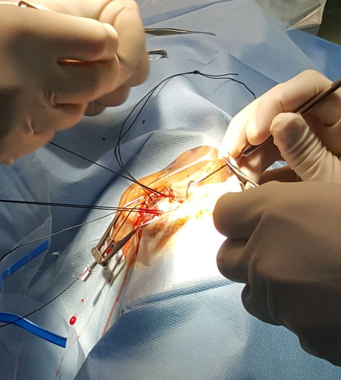 RD -Retinal detachment-