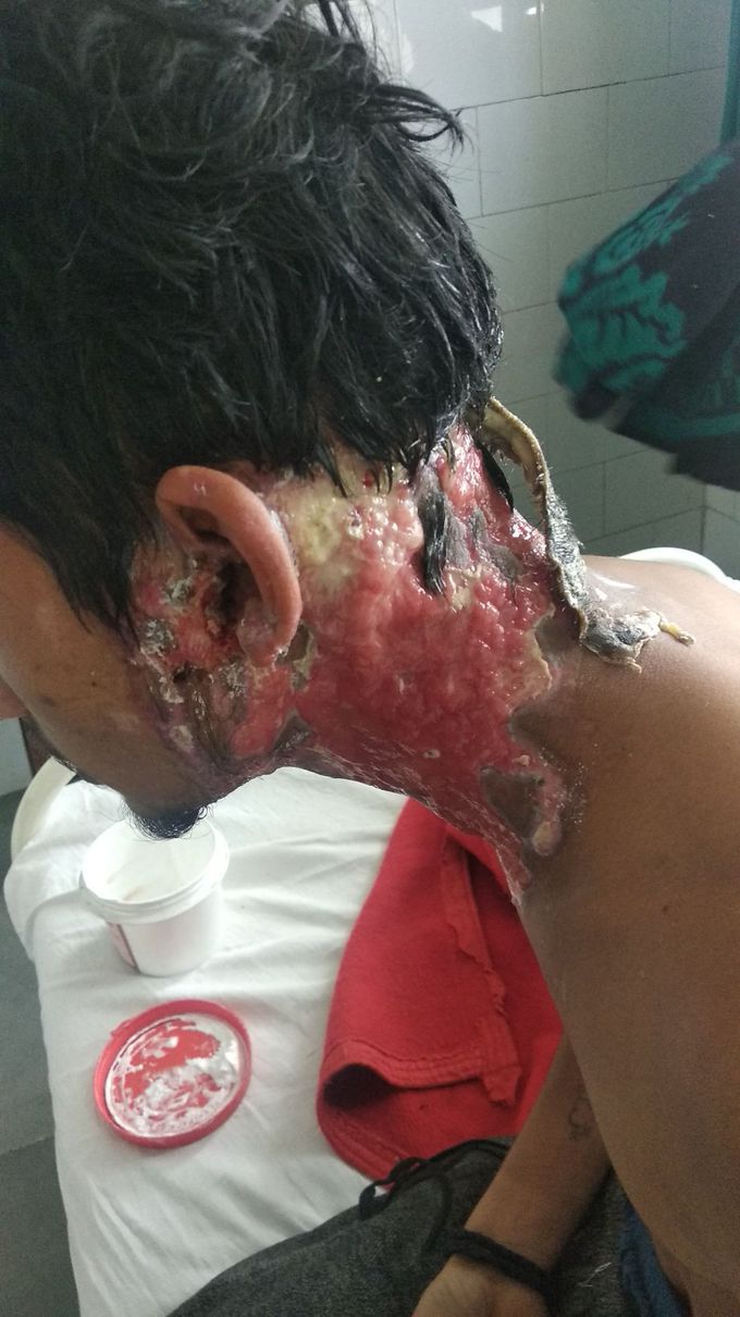 Acid burn