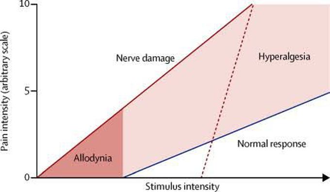 Treatment of allodynia