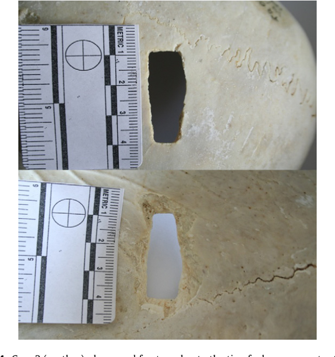 Case 2 (mother): depressed fracture due to the tip of a hammer: outer table of the skull (up); inner table of the skull (down).