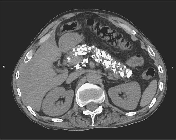 Calcific Pancreatitis Associated with Alcohol Use