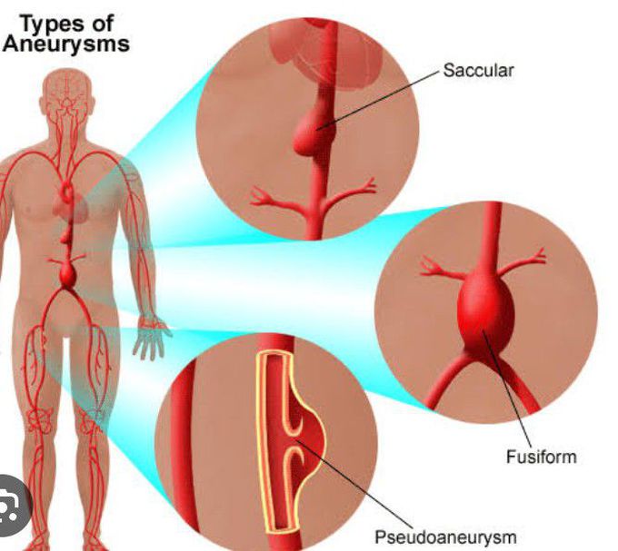 Types of Aneurysm