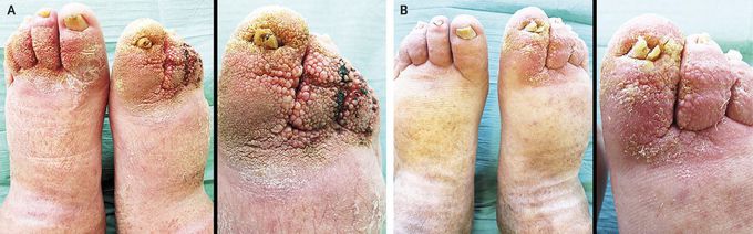 Papillomatosis Cutis Lymphostatica