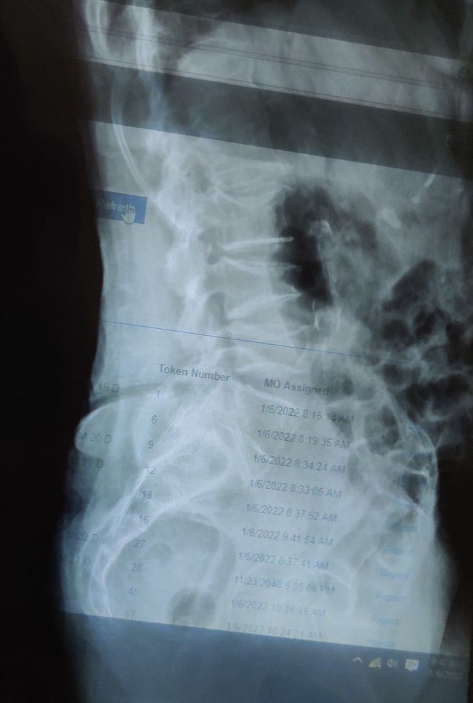 Osteoporotic Vertebral Compression Fracture