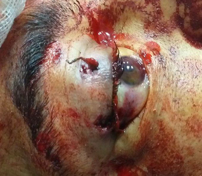Gunshot into eye
