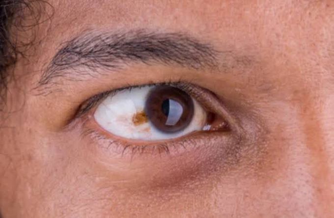Causes of Eye Melanoma