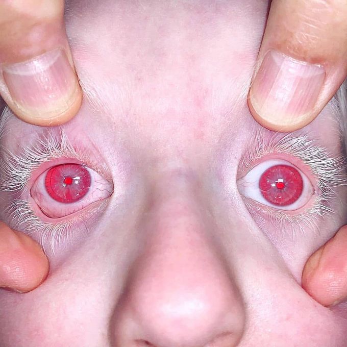 Ocular albinism