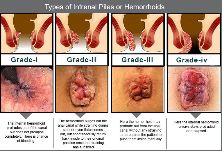 Image via: https://www.multicarehomeopathy.com/diseases/6-best-homeopathic-medicines-for-piles-which-can-avoid-surgery