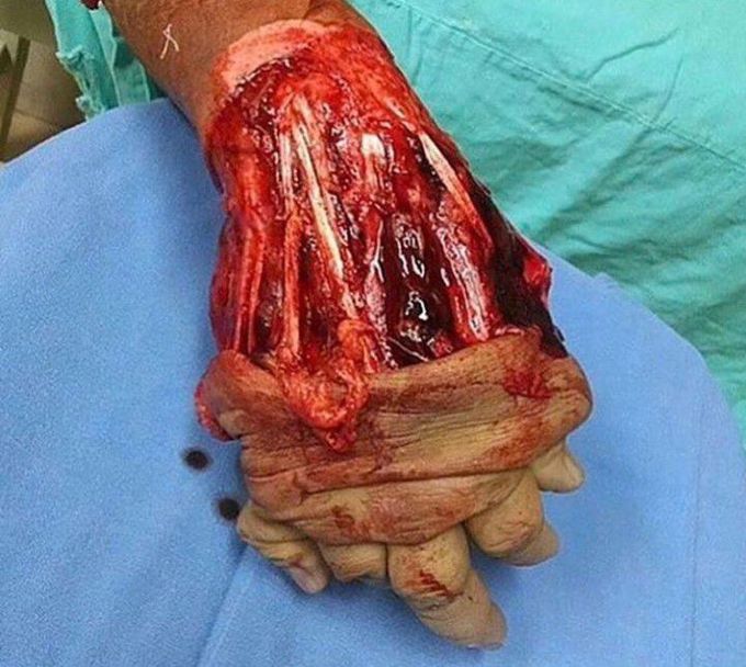 Degloving injury of the hand