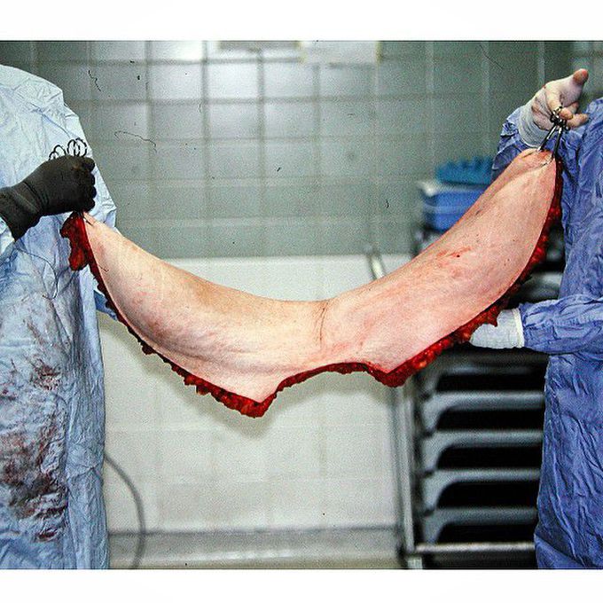 Abdominoplasty