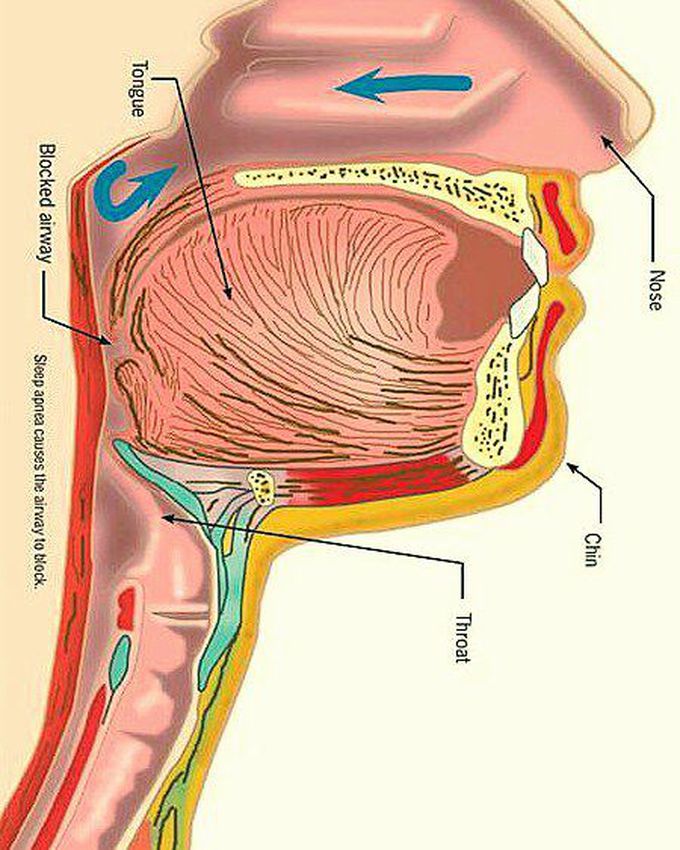 Sleep Apnea