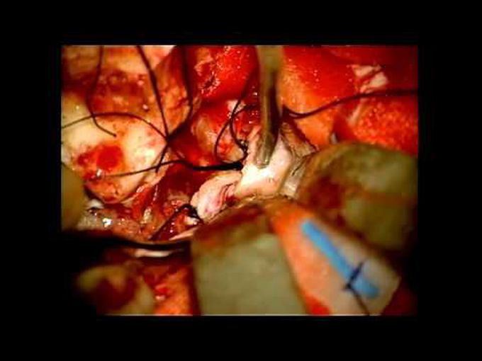 Combined petrosal approach for resection of petroclival meningioma
