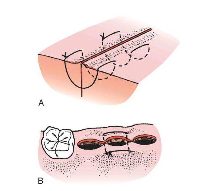 Horizontal mattress suture