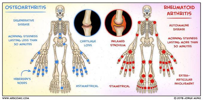 Difference between Osteoarthritis and rheumatoid arthritis