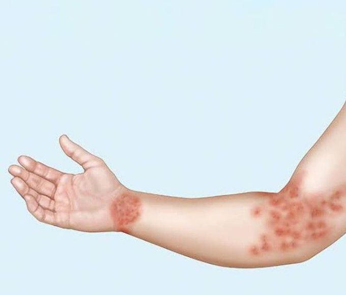 Symptoms of Discoid eczema