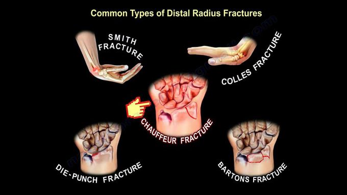 Distal Radius fracture-Types