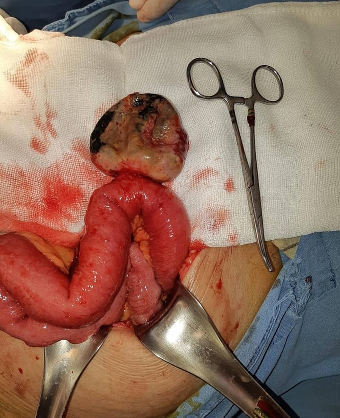 Gangrenous and perforated Meckel's diverticulum!