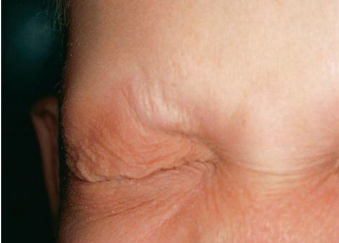 Ectodermal dysplasia