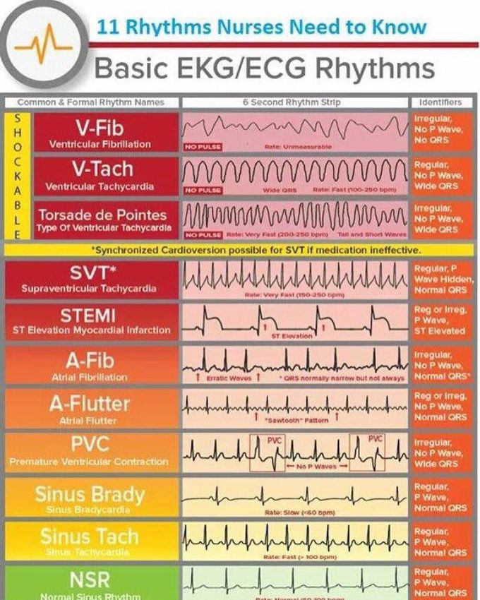 Basic Of ECG