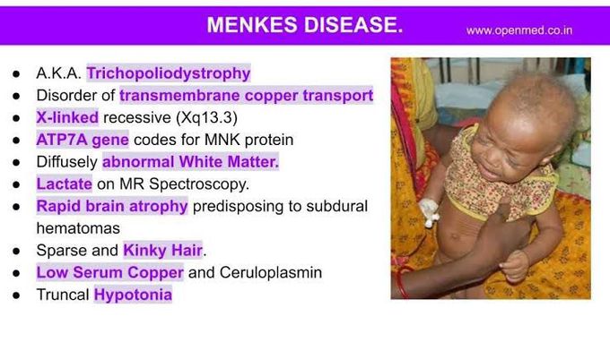 Causes of menkes disease