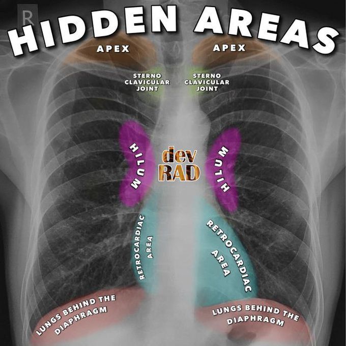 5 Hidden Areas in a Chest X-ray