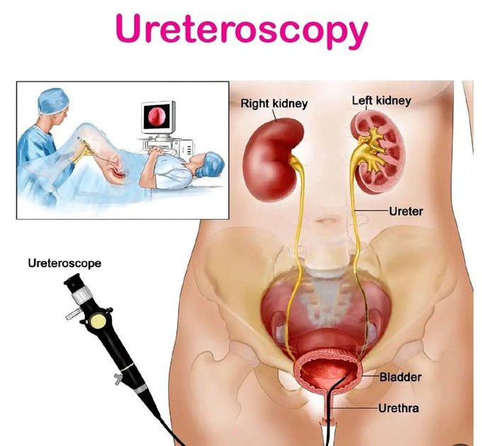 Uretroscopy