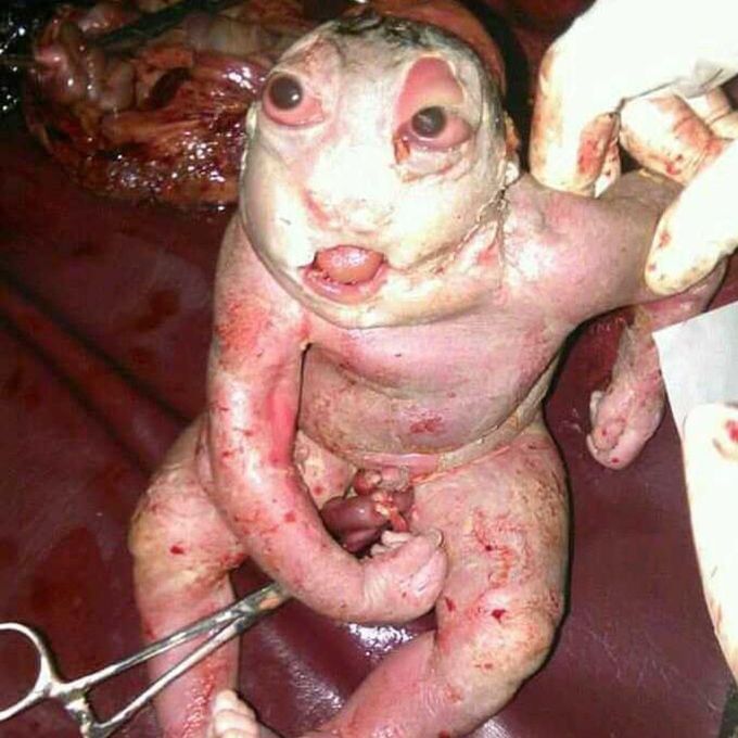 Fetus