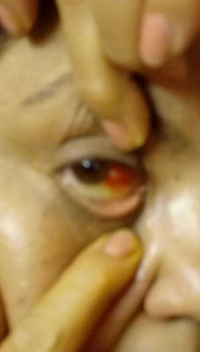 Redness in eye