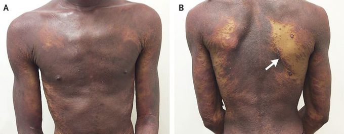 Erythrodermic Psoriasis and HIV Infection