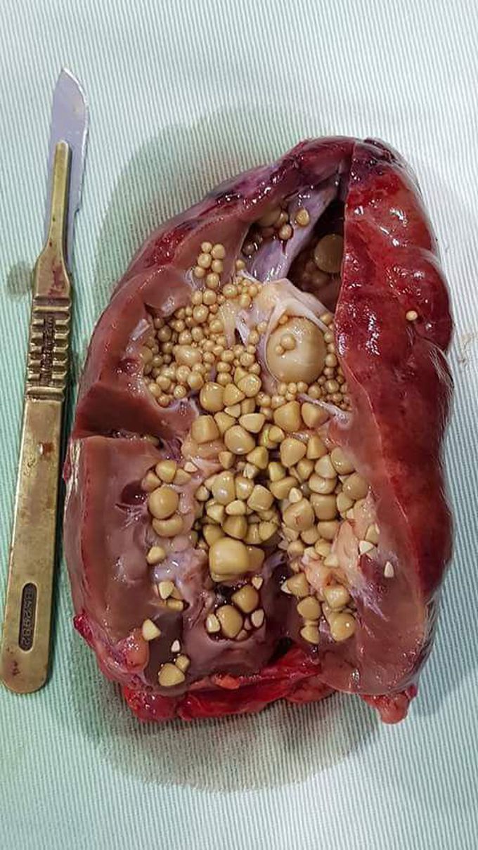 Massive amount of kidney stones 😵
