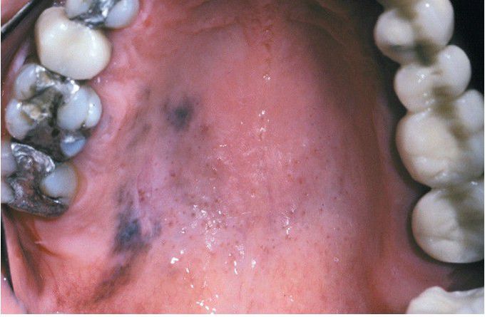 Oral Melanoma