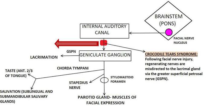 Crocodile tear syndrome