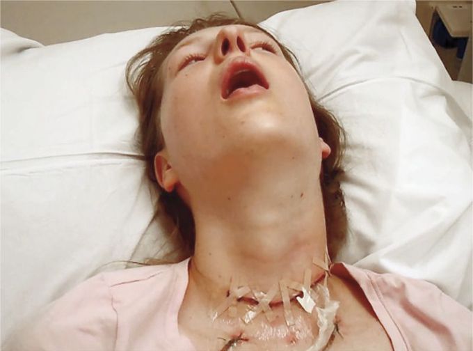 An Acute Dystonic Reaction after Treatment with Metoclopramide