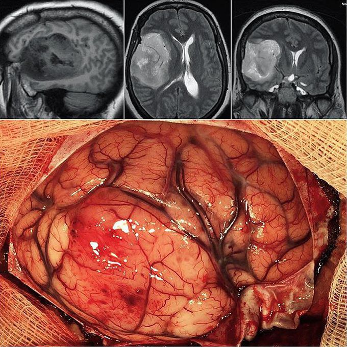 Glioblastoma multiforme