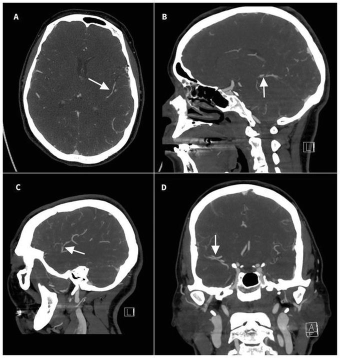 Thunderclap Headache