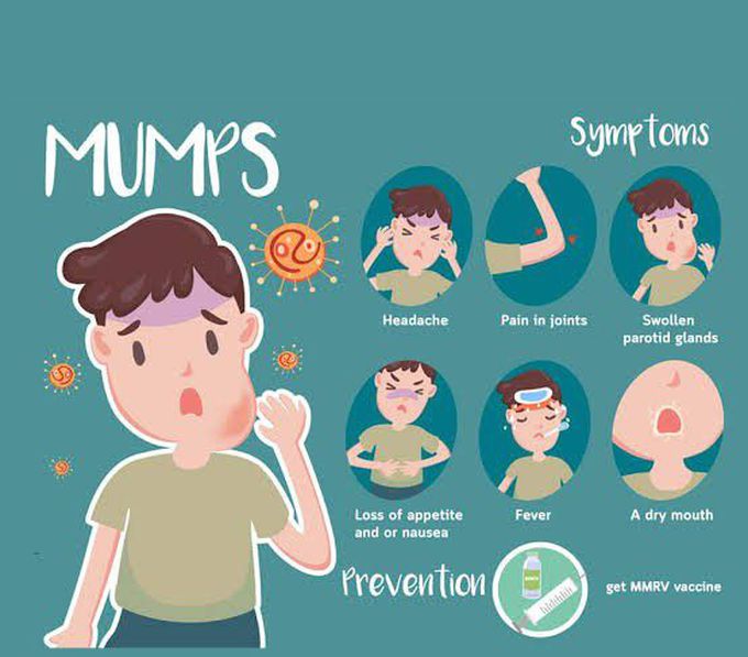 Symptoms of mumps.