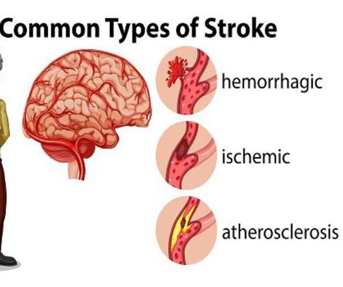 Types of Stroke