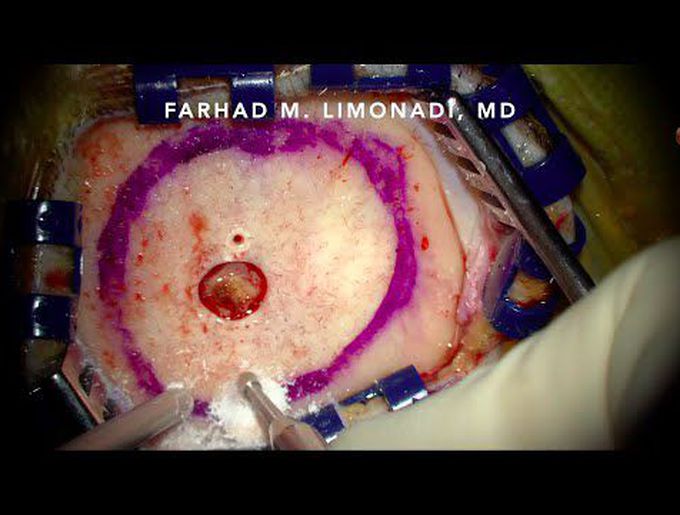Surgical removal of a metastatic brain tumor that failed radiation treatment.  Video presentation.