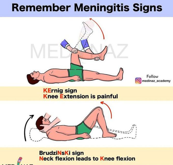 Signs of meningitis