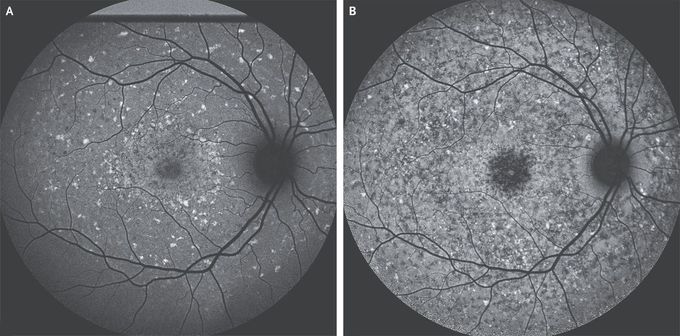 Stargardt Juvenile Macular Degeneration