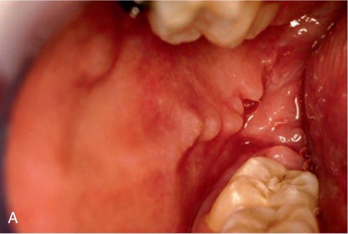 Nodules and ulcers of Crohn’s disease.