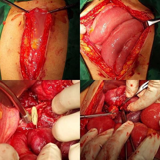 Peritonitis due to perforated appendix..