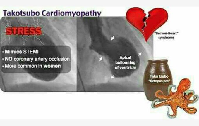 Broken heart syndrome - Takotsubo cardiomyopathy