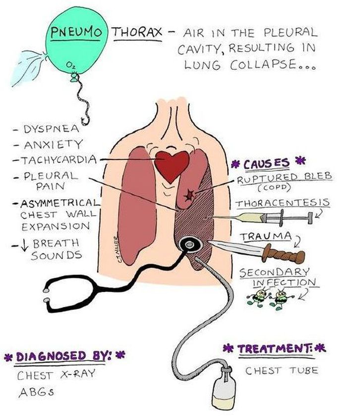 RESTRICTIVE LUNG DISORDER: PNEUMOTHORAX