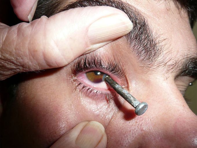 ⚠️Foreign body in the eye! 