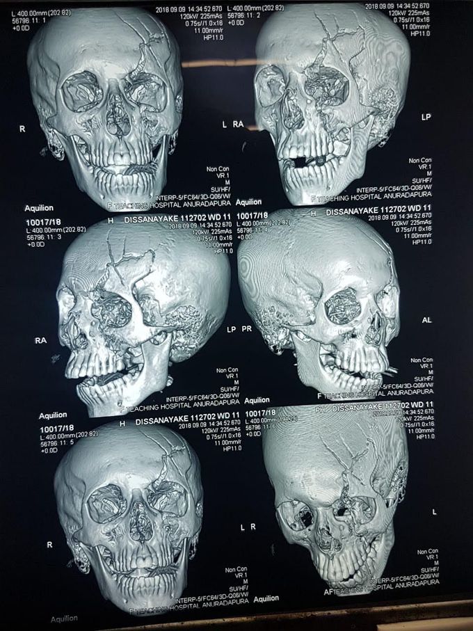 Head trauma