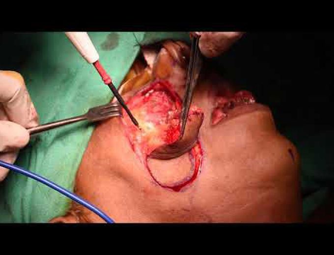 Islanded nasolabial flap for tongue reconstruction