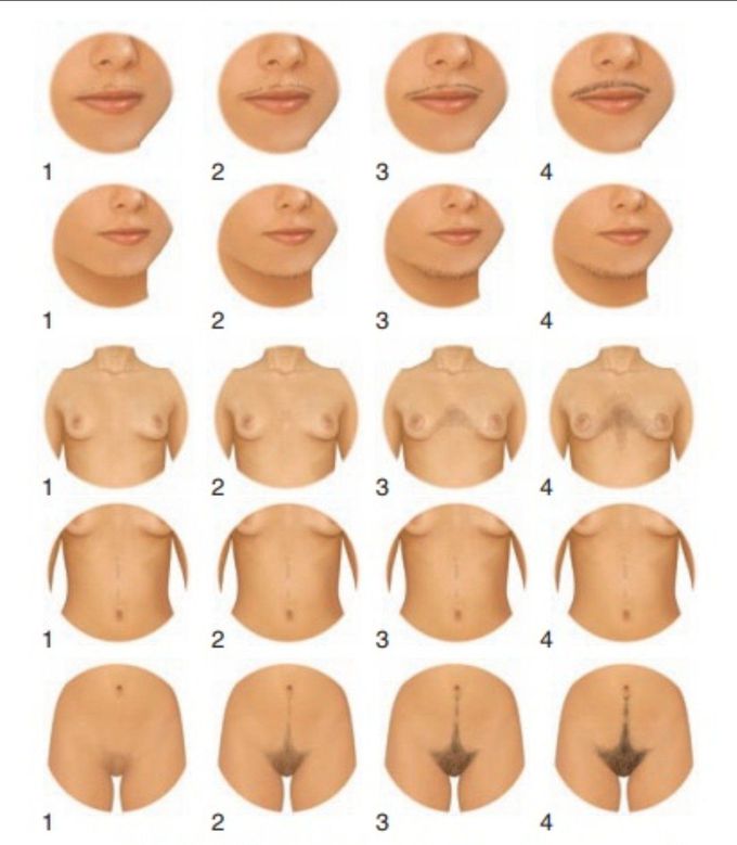 Hirsutism